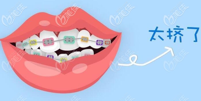 牙齒排列擁擠程度圖