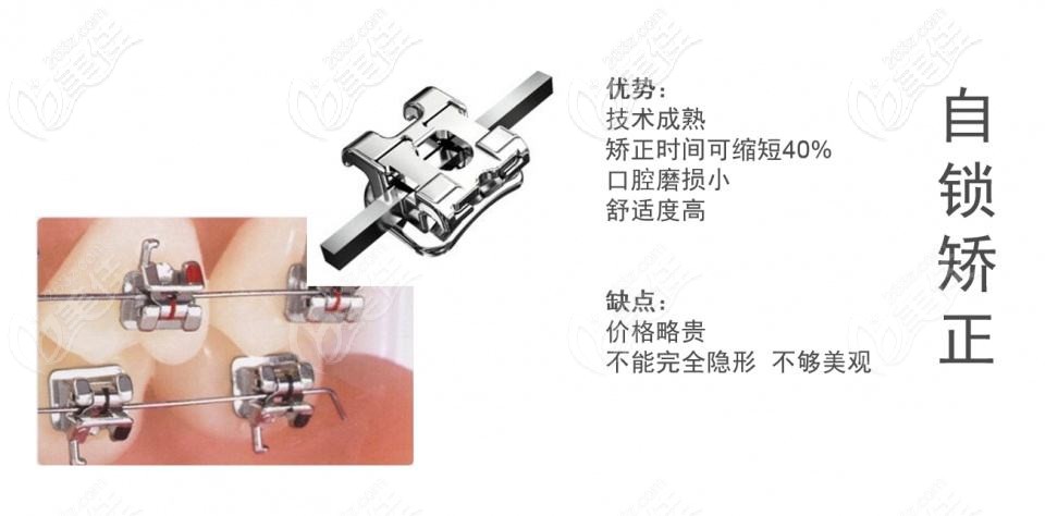 ?？谖⑿谇唤饘僮枣i矯正器