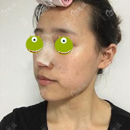 在鄭大<!--<i data=20240703-sp></i>-->院做鼻修復(fù)一周后