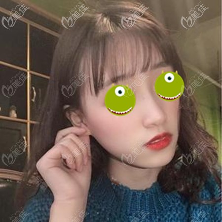 隆鼻失敗后將膨體換成了生科硅膠假體