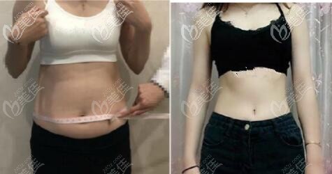 在石家莊雅芳做腰腹環(huán)吸前后對(duì)比照片 在石家莊雅芳做腰腹環(huán)吸前后對(duì)比照片