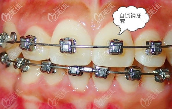 我的自鎖鋼牙套矯正經(jīng)歷 我的自鎖鋼牙套矯正經(jīng)歷