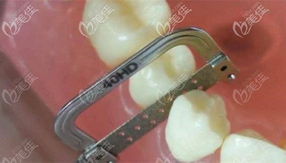 矯治牙齒咬合錯(cuò)亂還做了片切 矯治牙齒咬合錯(cuò)亂還做了片切