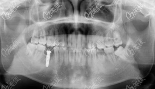 右下第一磨牙缺失選韓國(guó)登騰lmplantium種植體的效果也不錯(cuò)哦