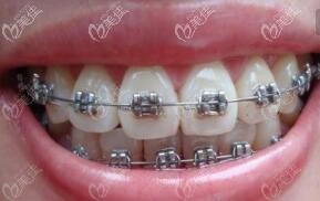 金屬自鎖鋼牙套