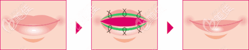 縮唇手術過程 縮唇手術過程