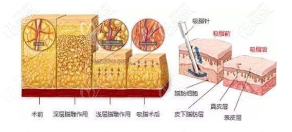 李弋院長(zhǎng)的維密脂雕術(shù)優(yōu)勢(shì)