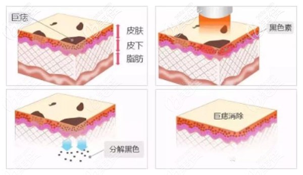 李晶醫(yī)生做激光祛痣的技術(shù)優(yōu)勢