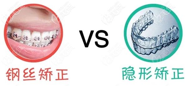 劉鋼醫(yī)生科普隱形牙套矯正和固定矯正選哪個好 劉鋼醫(yī)生科普隱形牙套矯正和固定矯正選哪個好