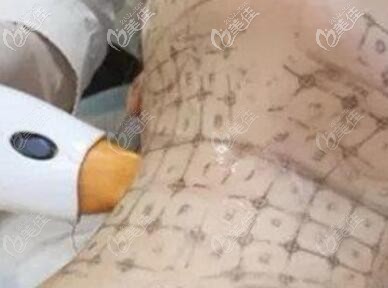 做頸部熱瑪吉除皺治療過程中 做頸部熱瑪吉除皺治療過程中