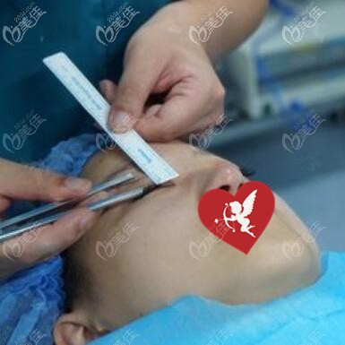 做埋線雙眼皮術(shù)前畫線設(shè)計(jì)