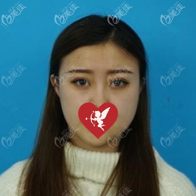 埋線雙眼皮術(shù)后10天恢復(fù)效果照