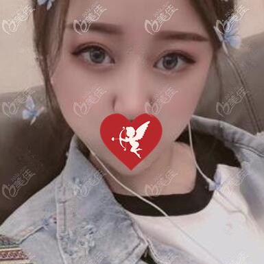 在薈做埋線雙眼皮7.5mm恢復(fù)后照片分享！