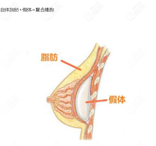復(fù)合隆胸的缺點是什么
