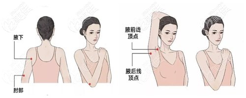 手臂吸脂分布圖 手臂吸脂分布圖