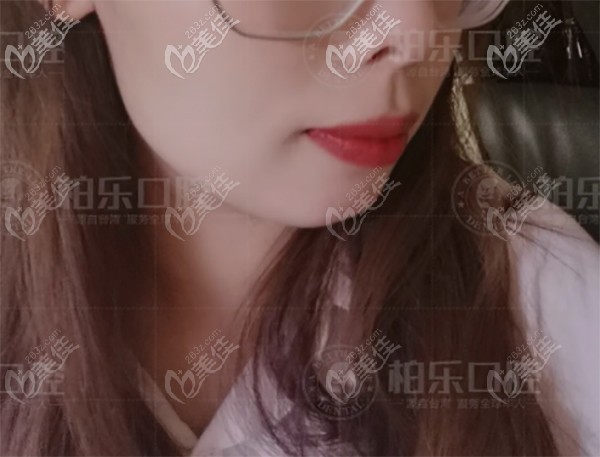 在南寧柏樂隱適美矯正牙齒深覆合 在南寧柏樂隱適美矯正牙齒深覆合