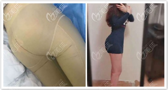 自體脂肪豐臀三個(gè)月效果對(duì)比圖 自體脂肪豐臀三個(gè)月效果對(duì)比圖