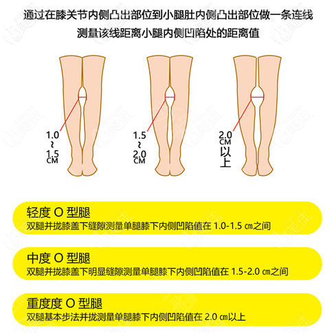 O型腿不同程度的自測方法 O型腿不同程度的自測方法
