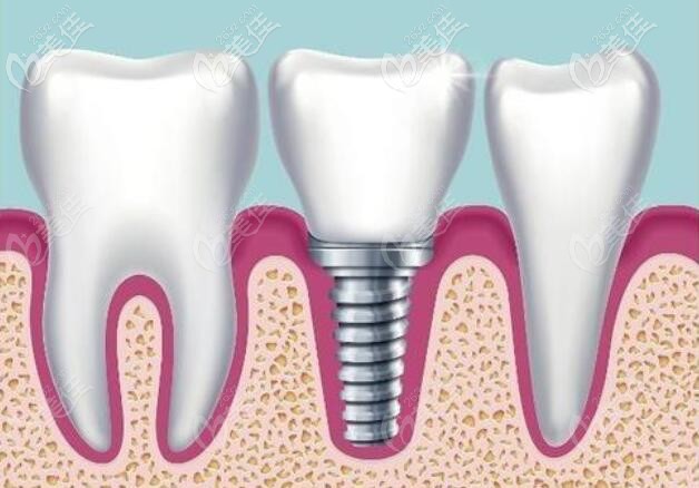 老年人種植牙高嗎 老年人種植牙高嗎