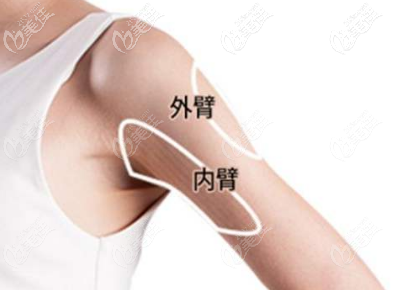 手臂吸脂的部位 手臂吸脂的部位