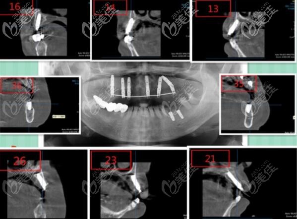 上半口ALL-ON-6即刻負(fù)重種植牙