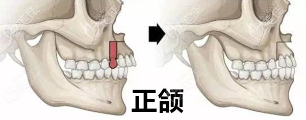 正頜手術(shù)示意圖