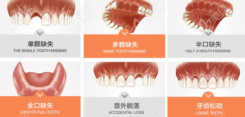 哪些人需要做種植牙 哪些人需要做種植牙