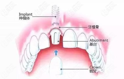 做一顆種植牙的流程圖 做一顆種植牙的流程圖
