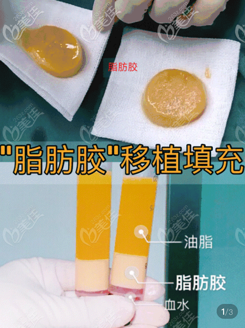 脂肪膠填充法令紋成活率高維持時(shí)間長(zhǎng) 脂肪膠填充法令紋成活率高維持時(shí)間長(zhǎng)