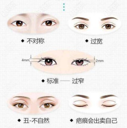 雙眼皮失敗的幾種圖片