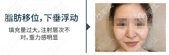 脂肪膠填充法令紋下垂移位情況 脂肪膠填充法令紋下垂移位情況