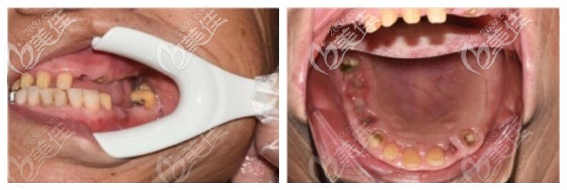 三亞鼎點(diǎn)口腔上半口缺失案例