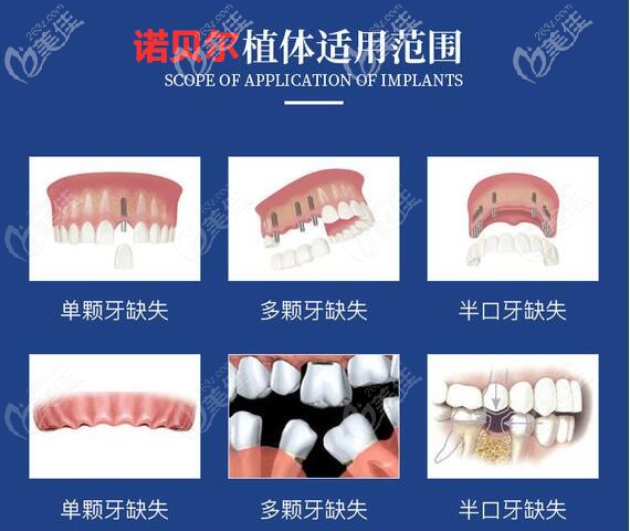瑞典諾貝爾種植牙的適用范圍