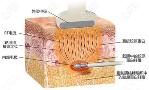 寶麗太吸脂原理圖