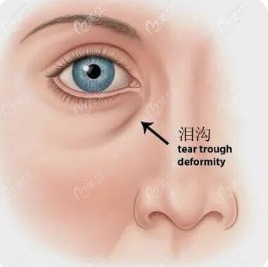淚溝的位置 淚溝的位置