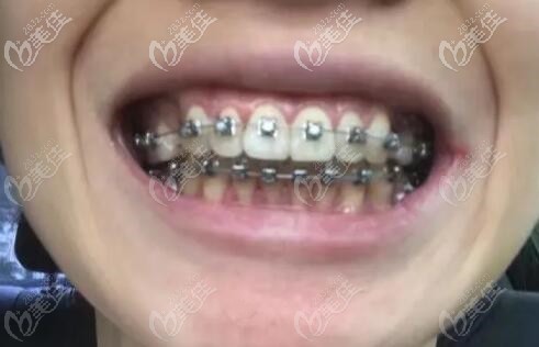 在廣州華醫(yī)口腔戴的金屬自鎖牙套