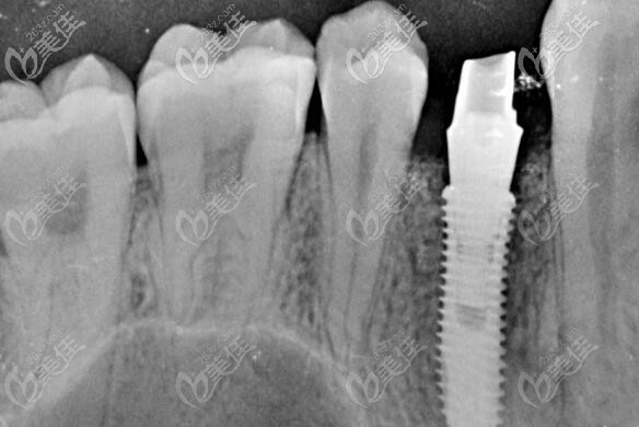 單顆種植牙缺失 單顆種植牙缺失