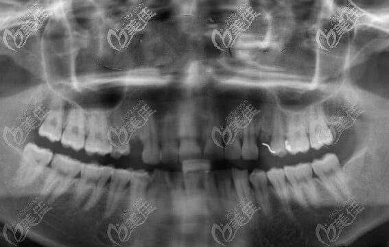 單顆缺失口腔X線片 單顆缺失口腔X線片