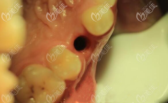 單顆缺失種植牙設(shè)計(jì) 單顆缺失種植牙設(shè)計(jì)