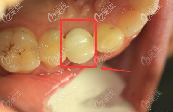 韓系單顆種植牙案例 韓系單顆種植牙案例