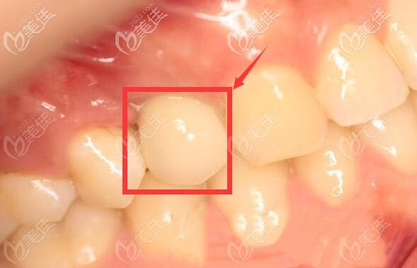 解答:天津河西區(qū)雅爾美口腔做單顆韓系種植牙需要多長時(shí)間