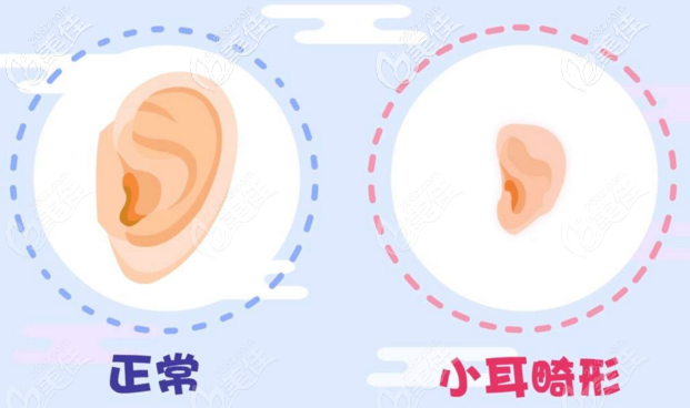 正常的耳朵和小耳畸形的區(qū)別 正常的耳朵和小耳畸形的區(qū)別