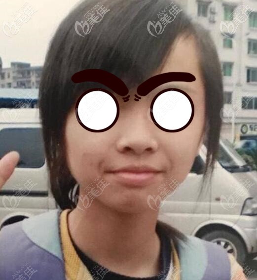 齙牙矯正前正面樣子 齙牙矯正前正面樣子