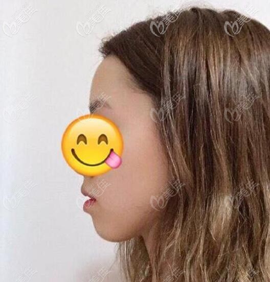 齙牙矯正前從側(cè)臉上看下巴后縮特別厲害 齙牙矯正前從側(cè)臉上看下巴后縮特別厲害