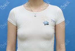 第二次脂肪豐胸的樣子