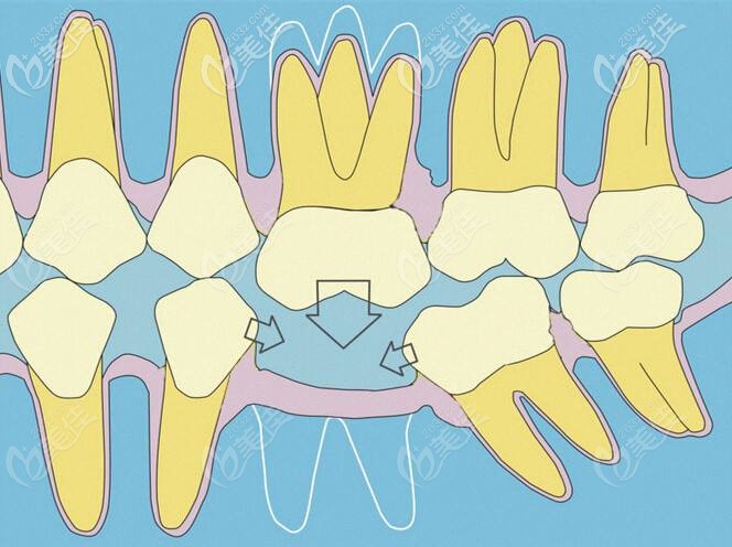 單顆牙齒缺失的危害 單顆牙齒缺失的危害
