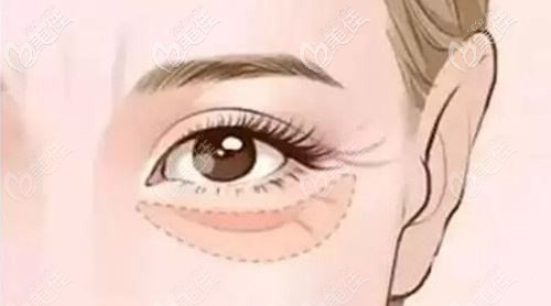 臥蠶過大會(huì)容易形成眼袋