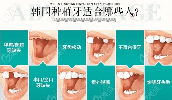 適合做種植牙的人群 適合做種植牙的人群