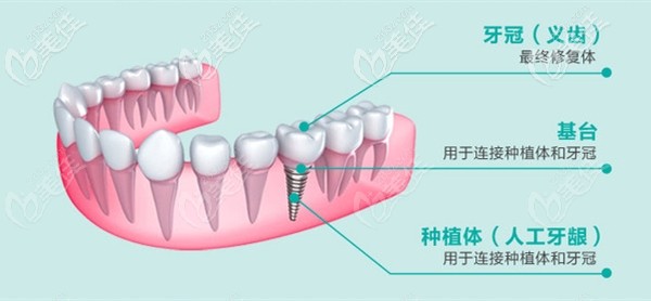 種植牙機(jī)構(gòu)示意圖 種植牙機(jī)構(gòu)示意圖