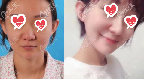 北京美萊隆鼻案例 北京美萊隆鼻案例